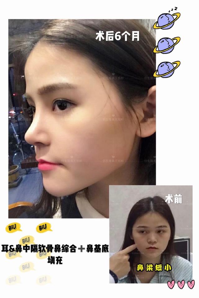 隆鼻手术十大常见问题的应对方案,隆鼻手术前应该准备带什么东西