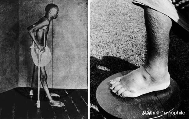 日本人以前得脚气病是什么原因,日本人为什么有脚气