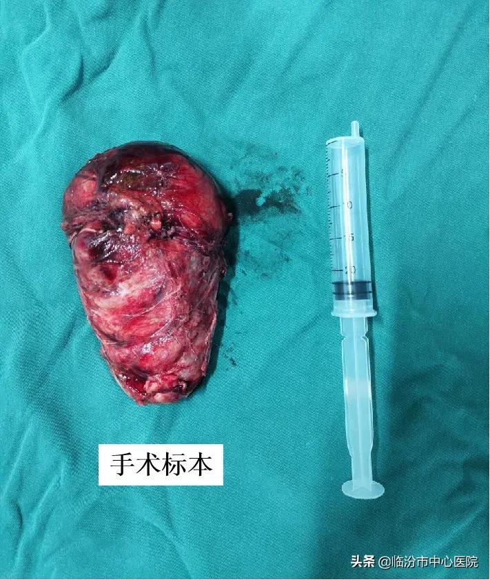 临汾市中心医院手术,临汾市中心医院腹腔镜手术