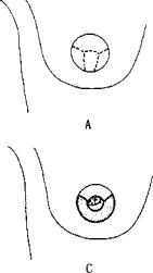 乳头及乳晕的再造