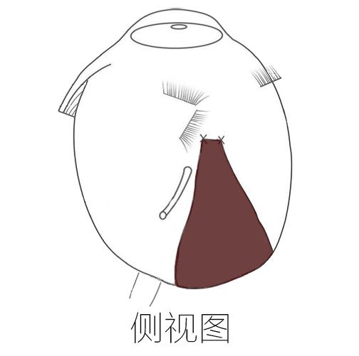 巩膜加固为什么能防止视网膜脱落,后巩膜加固术近视度数降低