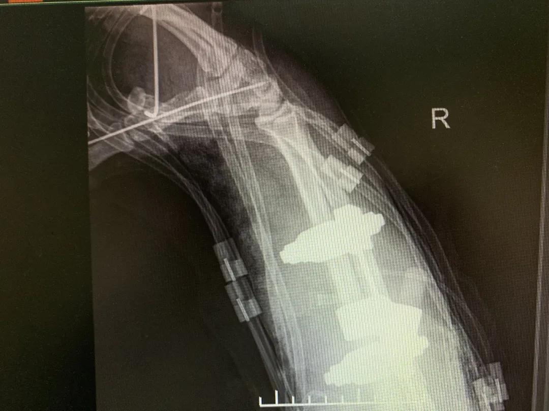 【日照市人民医院】右臂卷入机器被撕裂　6.5小时成功复活