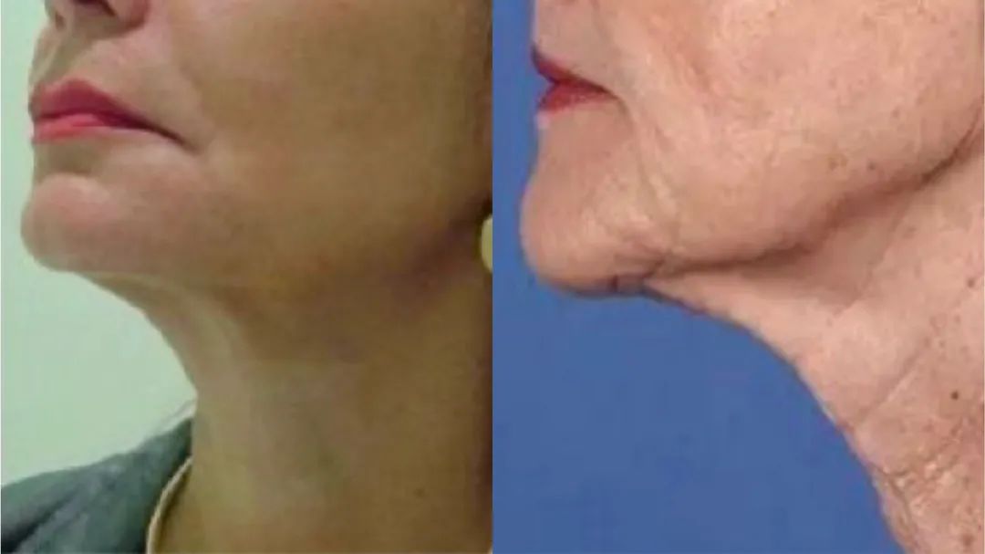 让下颚越来越清晰,下颌缘不清晰的原因