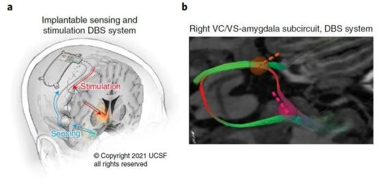 dbs脑深部电刺激术治疗强迫症吗,脑深部电刺激对帕金森效果如何