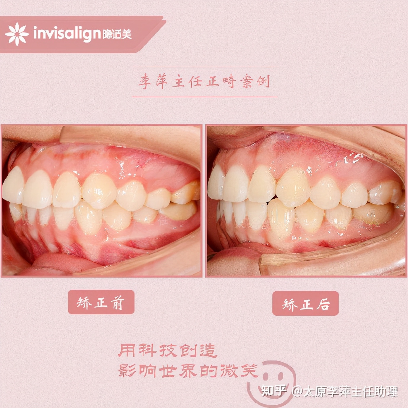 重度拥挤矫正牙齿适合隐形牙套吗,广州成人牙齿矫正推荐隐形牙套