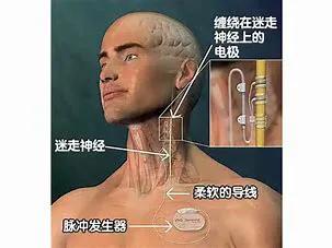 磁共振报告没有病灶，还能做癫痫外科手术吗？