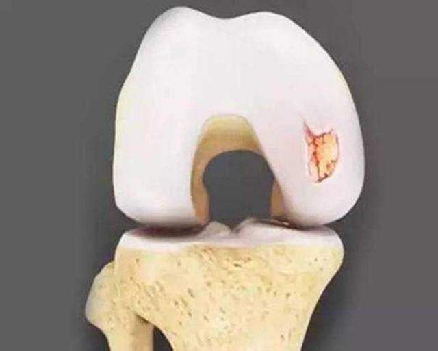 关节炎前期的症状和治疗方法,关节炎基础与临床