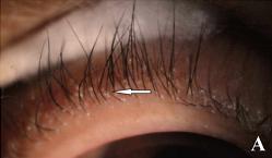 眼部螨虫，心灵窗户中不可忽视的隐秘角落，药师教您轻松预防治疗