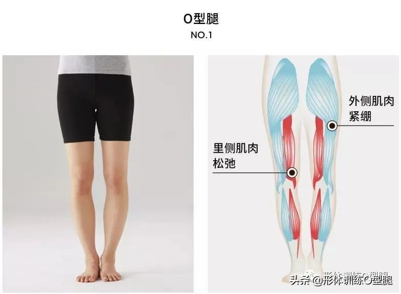 怎样矫正o型腿罗圈腿,罗圈腿和o型腿是怎么形成的