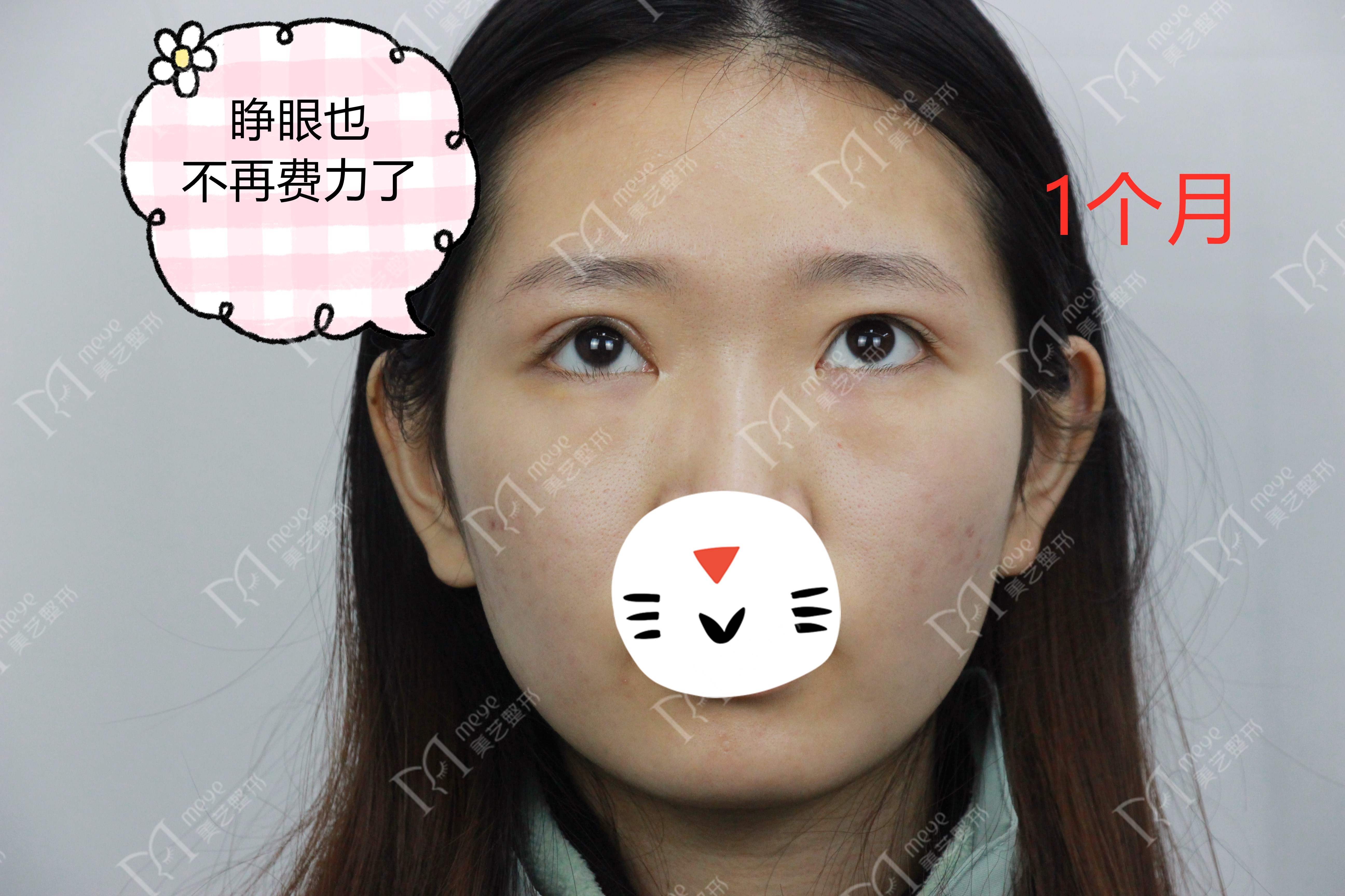 单眼上睑下垂修复术,上睑下垂眼睛修复手术成功率高吗