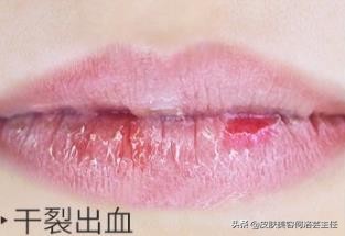 唇部干裂护理方法,嘴唇干裂起皮护唇推荐