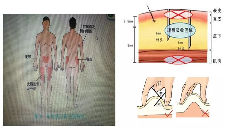 糖尿病酮症的急救及护理,2型糖尿病的住院治疗方案