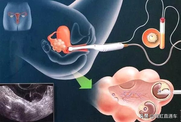 全球首例试管婴儿在哪国,日本试管婴儿有多少人