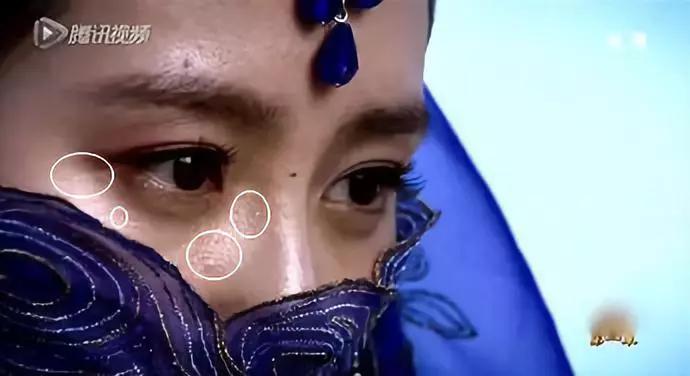 脂肪粒怎么用针挑出的,脂肪粒多久可以用针挑出来