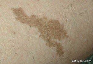 如何阻止咖啡斑增长,怎么避免咖啡斑长脸上