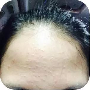 挤痘进了ICU，连下两次病危通知？这痘痘到底还能不能挤！