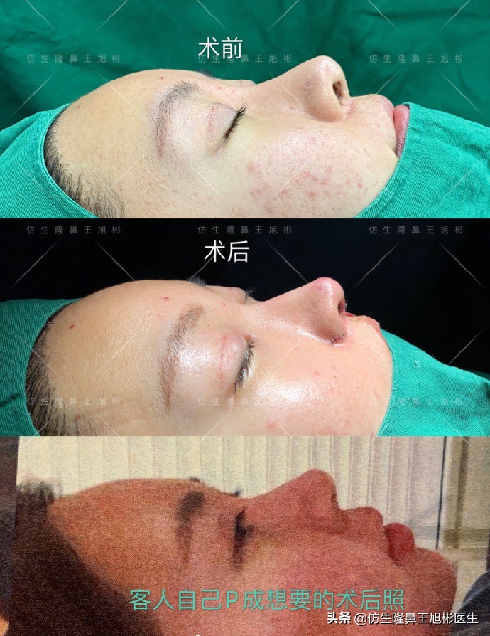 隆鼻的鼻翼怎么修复,隆鼻后多久可以做鼻翼缘矫正