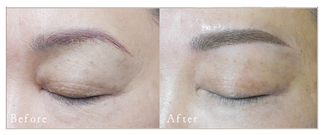 激光洗红眉的操作方法视频,红眉能激光吗