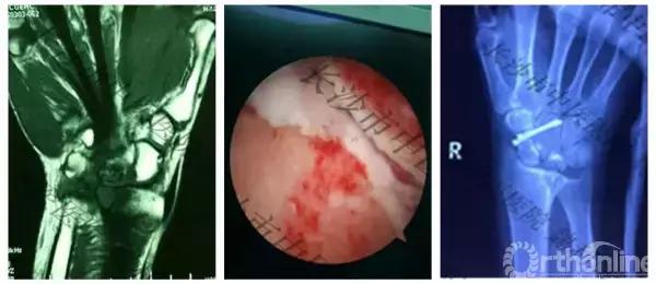 手腕囊肿抽吸出来后可否继续按压,足背囊肿穿刺好还是切除好