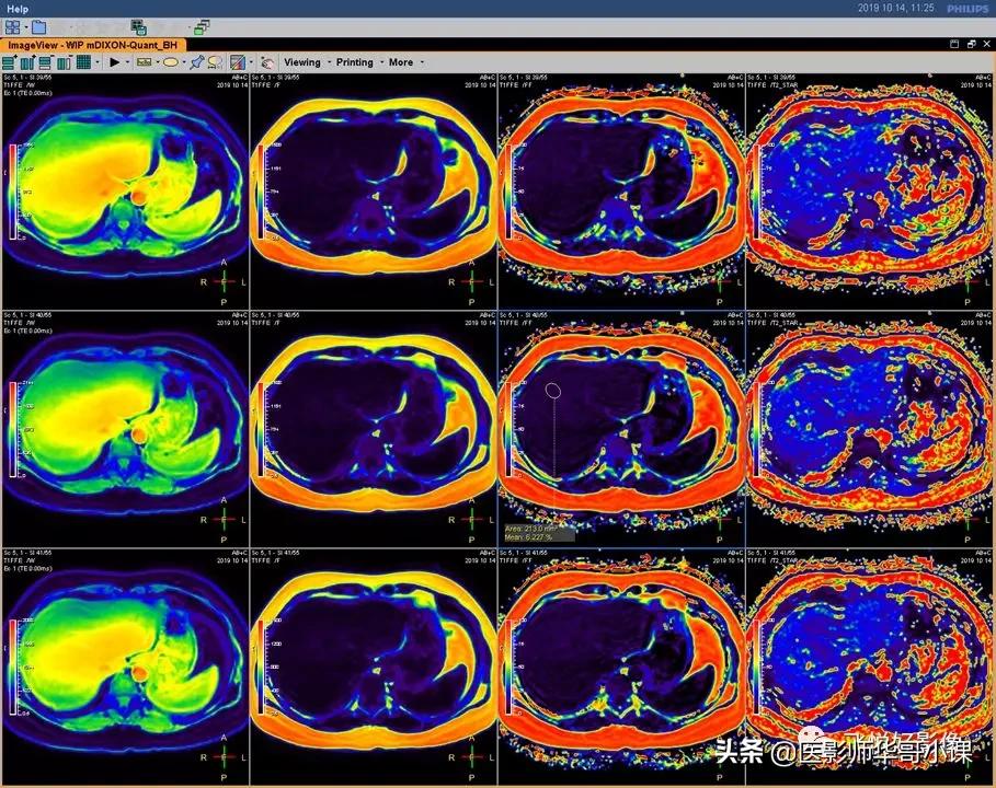 飞利浦磁共振快速扫描方案指南,飞利浦1.5t磁共振各部位扫描技术