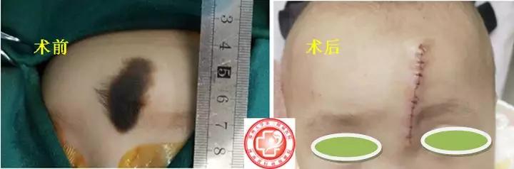 超减张缝合术哪里做的好,超减张精细缝合术如何修复疤痕