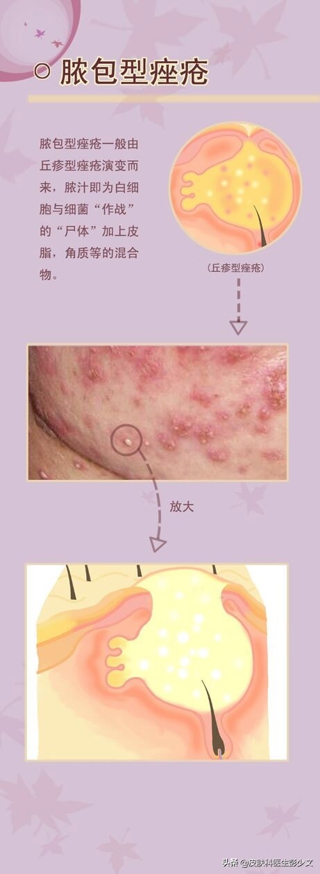 痘疮怎么治疗最快啊,身体长痘长疮怎么办最快消除