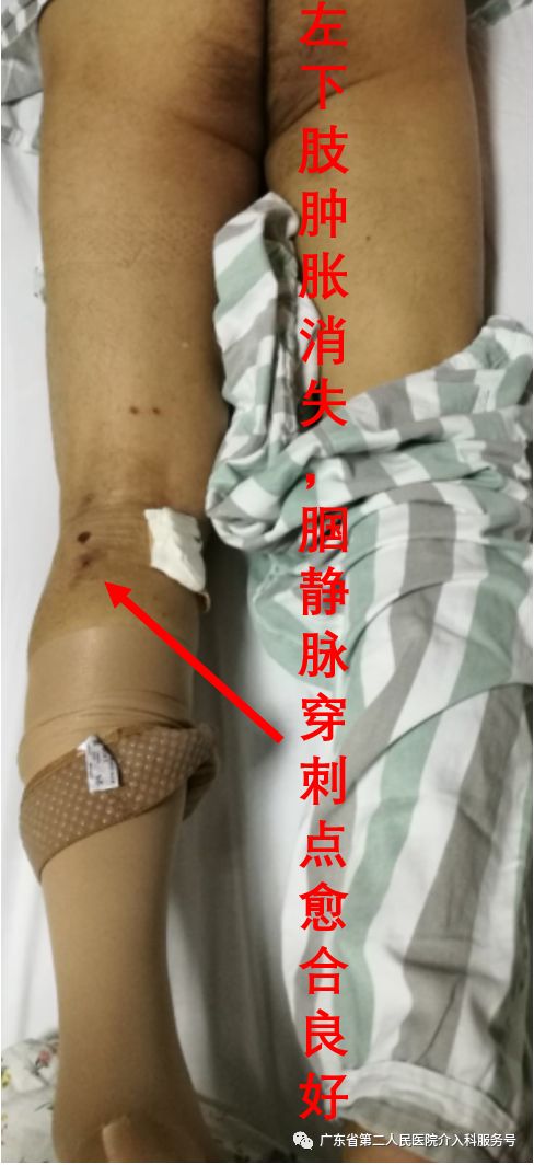 左腿血栓肿胀能完全恢复正常吗,左腿血栓肿痛怎么锻炼