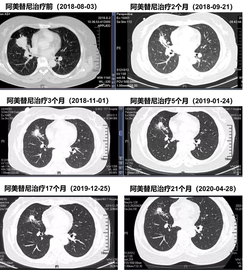 豪森药业阿美替尼治疗厄洛替尼经治T790M+肺腺癌伴脑转移病例分享