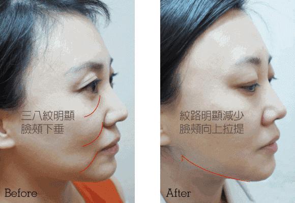 医生谈线雕面部提升危害,线雕提升能做吗