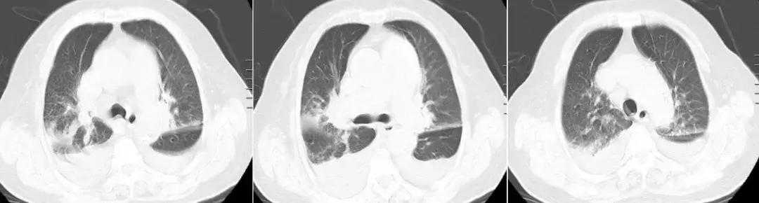 为什么说这个「古老」工具或许应重归呼吸医生的视野?