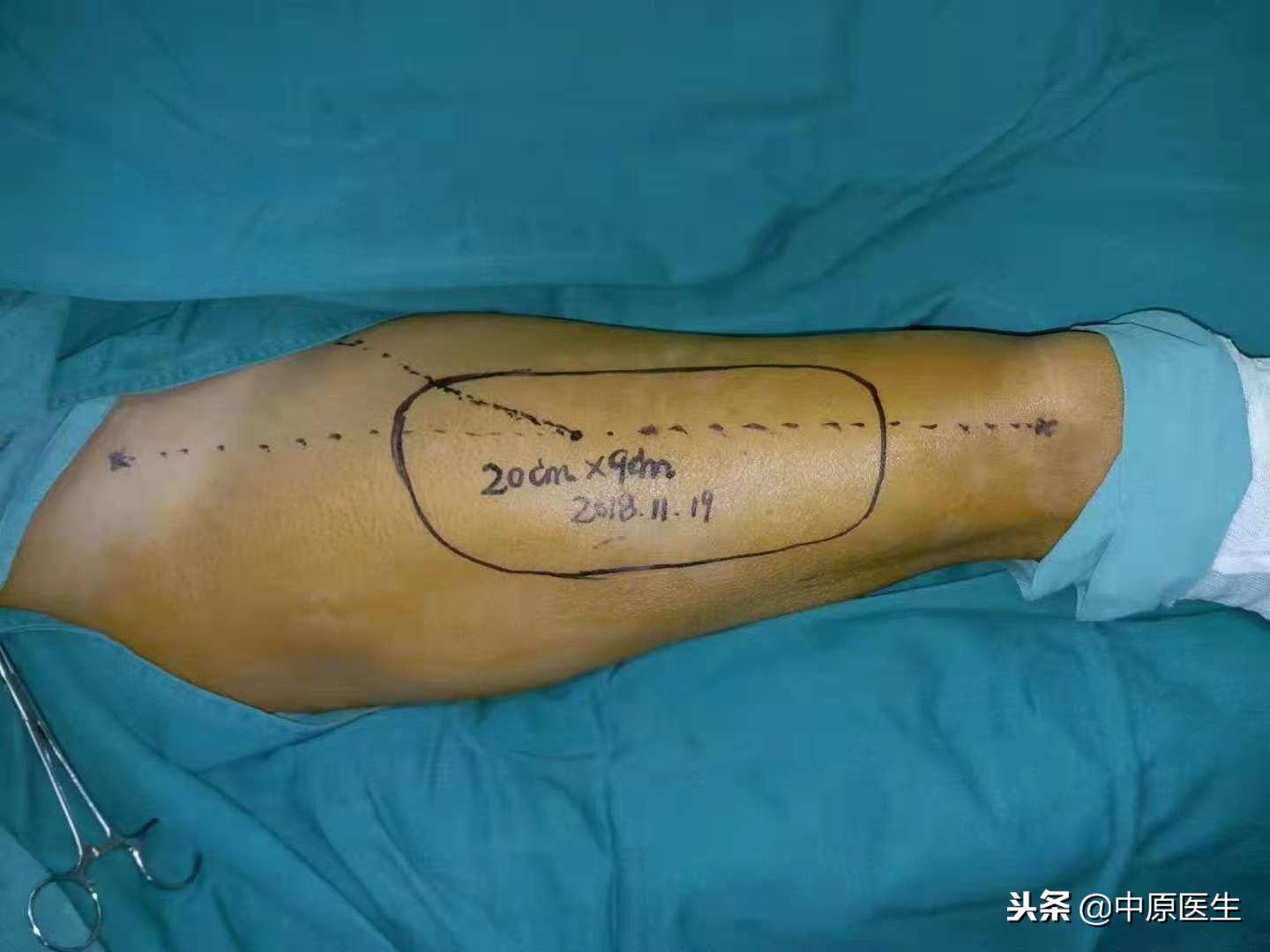 移花接木巧治癌症