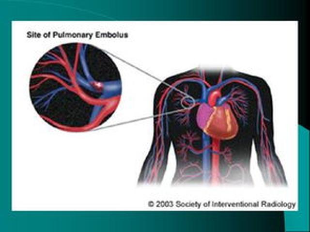女孩崴到脚了怎么办,女孩脚崴伤