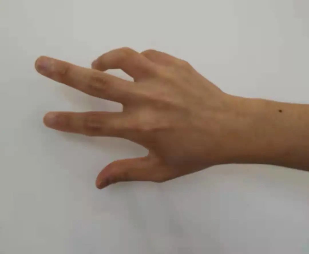 手麻肌电图检查过程视频,手麻脚麻肌电图正常