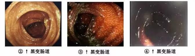 肠润茶和肠清茶区别,大肠会越煮越老吗