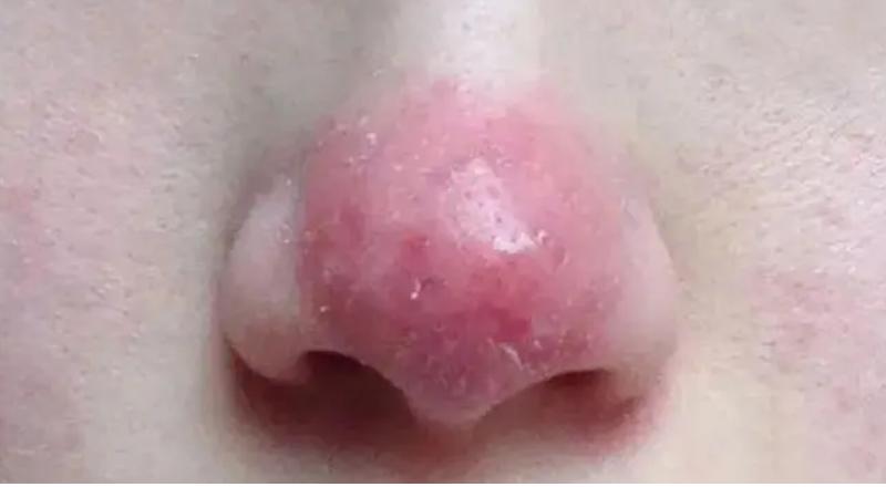 去黑头为什么黑头越来越多,长了黑头到底能不能挤