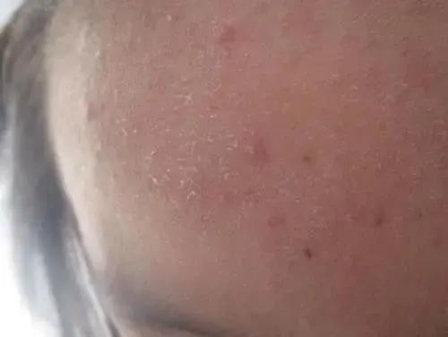 空调房皮肤干燥痒怎么快速解决,屋里干燥皮肤痒