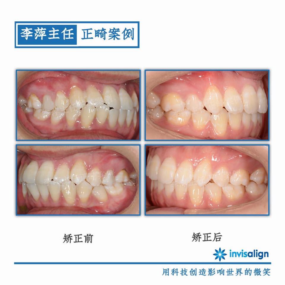 深覆合牙齿不齐矫正案例,29岁牙齿矫正龅牙前突案例