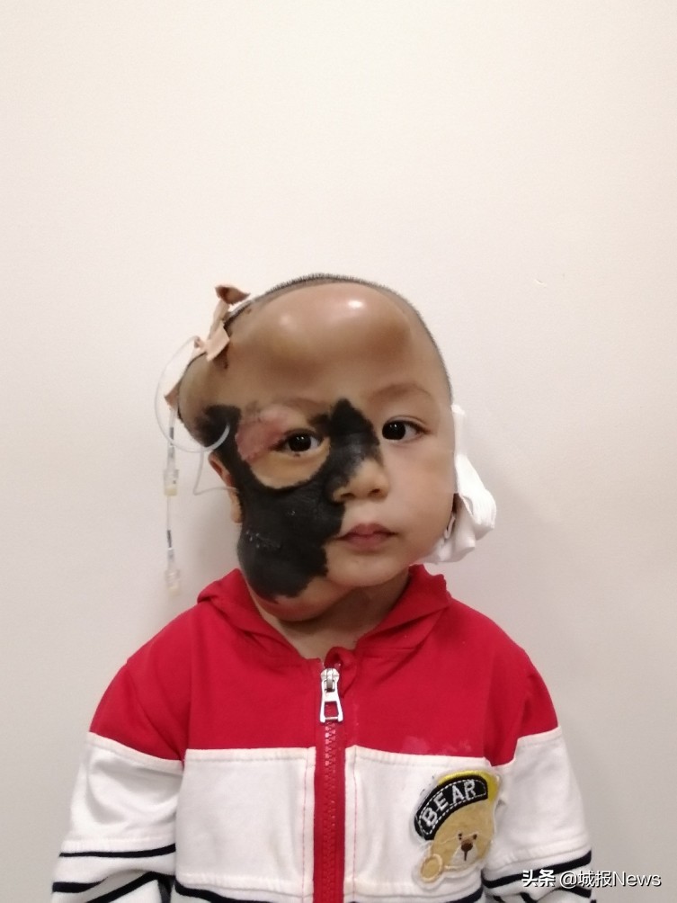 “巨痣”症男童有望告别“熊猫脸”