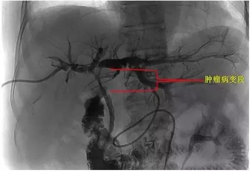 胆管恶性肿瘤保守治疗,胆道射频消融的危害
