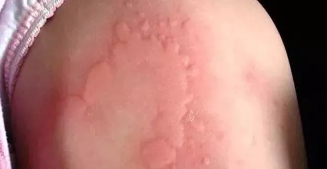 被蚊子咬了什么症状是得病了,被蚊子咬了出现的症状和解决方法