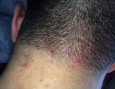 头皮上长疙瘩是什么原因,头皮上长疙瘩什么原因引起的