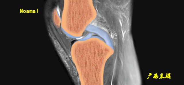 交叉韧带损伤的mr表现,后交叉韧带损伤的诊断实验