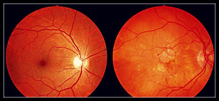 黄斑视网膜病变,黄斑病变会导致夜间视力下降