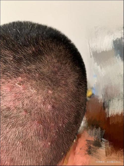 怎么根治头皮长痘的方法,如何解决头皮长痘