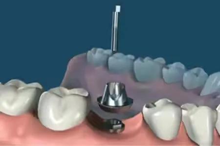 种植牙手术流程图解,口腔种植牙护士手术配台流程