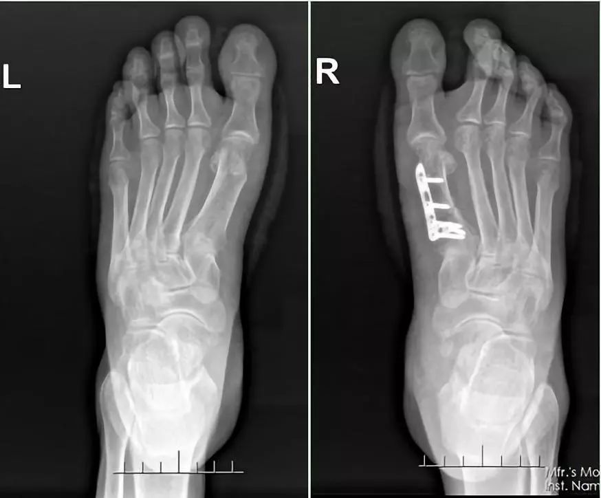 双足拇外翻需要手术吗,拇外翻矫形