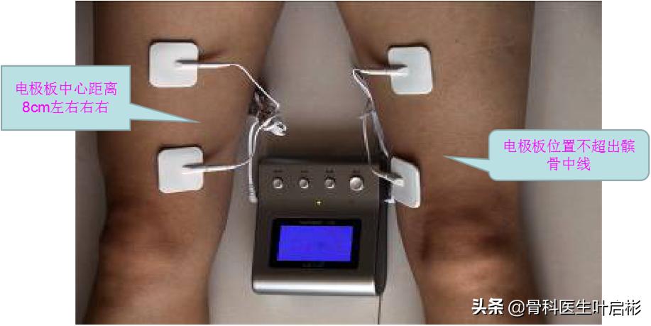 髌骨软化症髌骨矫正,髌骨软化半脱位怎么治疗才能治愈