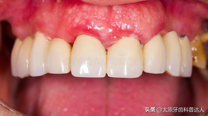 牙床肿怎么快速消肿,牙床反复肿怎么回事