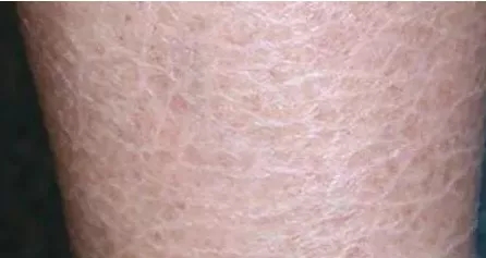 小腿后跟干裂起鱼鳞是什么原因,脚后跟像鱼鳞一样一层层干裂图