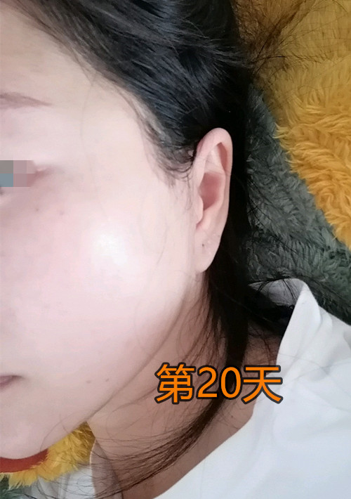 内窥镜拉皮除皱效果,48岁做内窥镜拉皮手术亲身经历